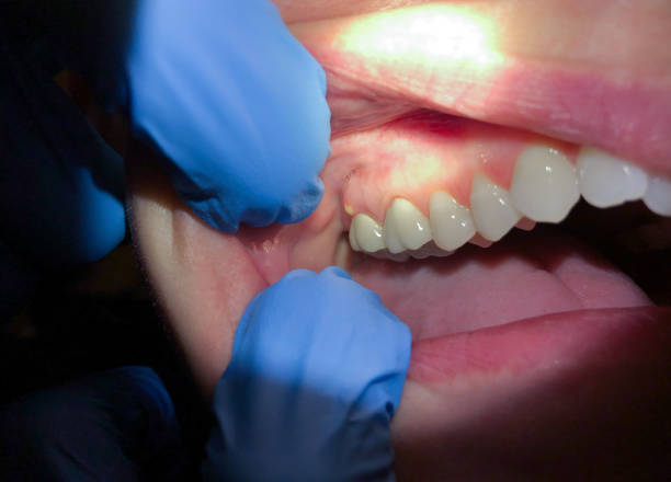 Best Emergency Wisdom Tooth Extraction in Whitfield, FL